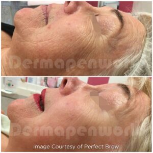 Aging Skin Treatment