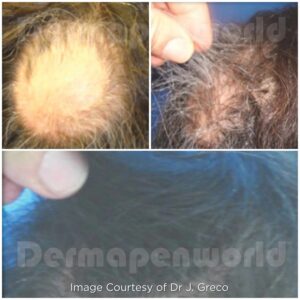 Alopecia Treatment