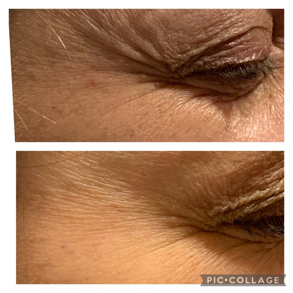 Crow's Feet Treatment