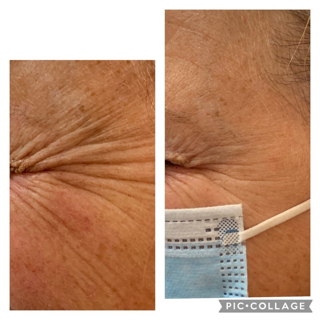 Crow's Feet Treatment