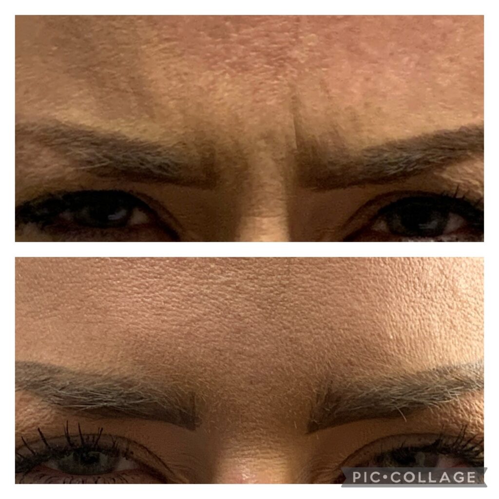 Glabella Treatment
