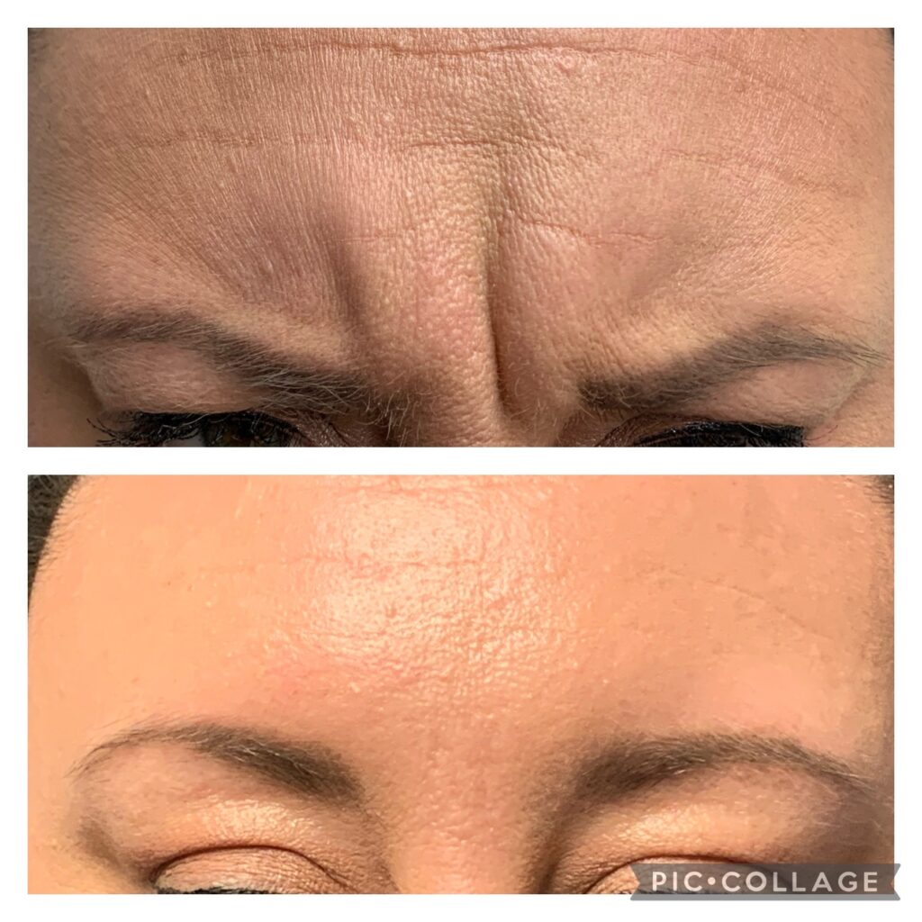 Glabella Treatment