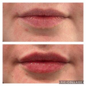 Filler Before/After