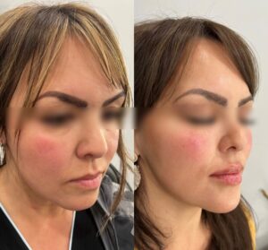 Filler Before/After