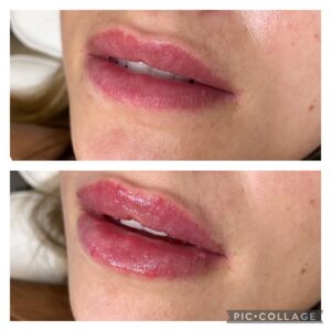 Filler Before/After