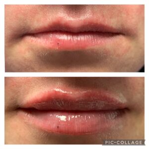 Filler Before/After