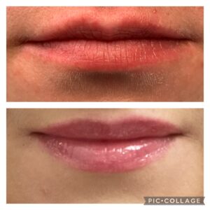 Filler Before/After