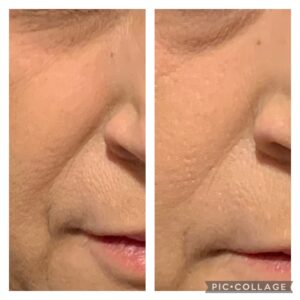 Filler Before/After