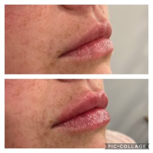 Filler Before/After