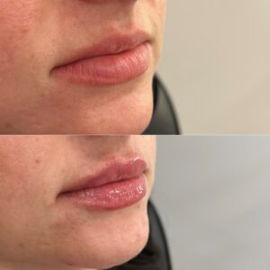 Filler Before/After