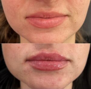 Filler Before/After