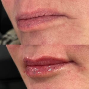 Filler Before/After