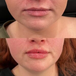 Filler Before/After