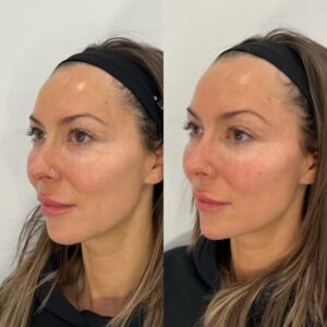 Filler Before/After