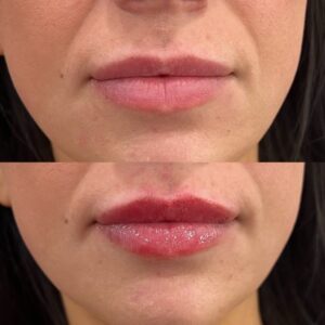 Filler Before/After