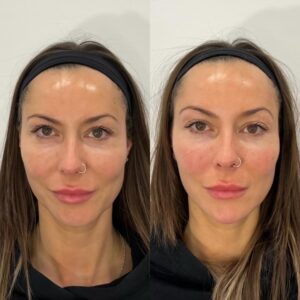 Filler Before/After