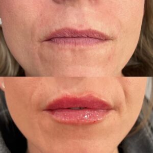 Filler Before/After