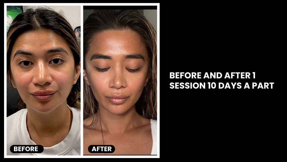 EXO-NAD Chemical Peel