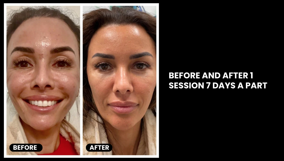 EXO-NAD Chemical Peel