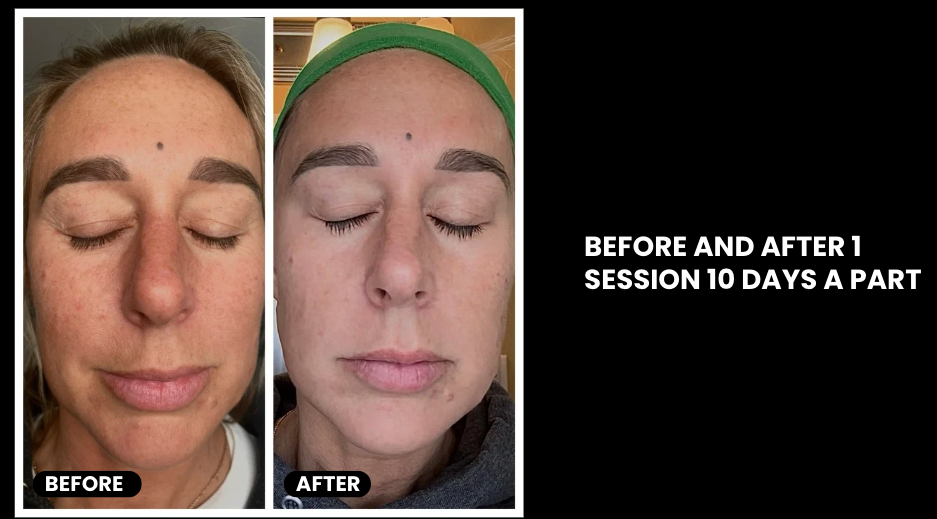 EXO-NAD Chemical Peel