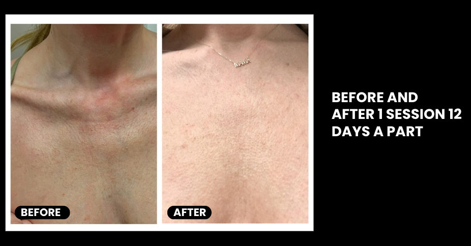EXO-NAD Chemical Peel