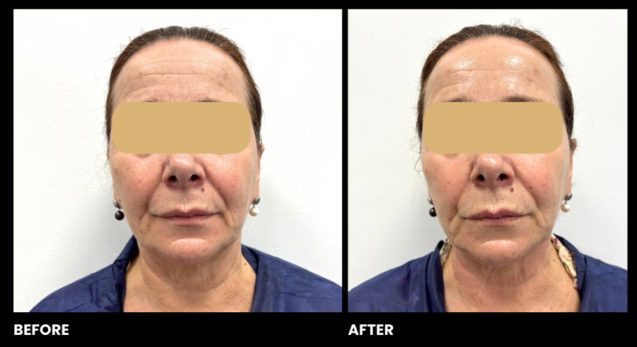 EXO-NAD Chemical Peel