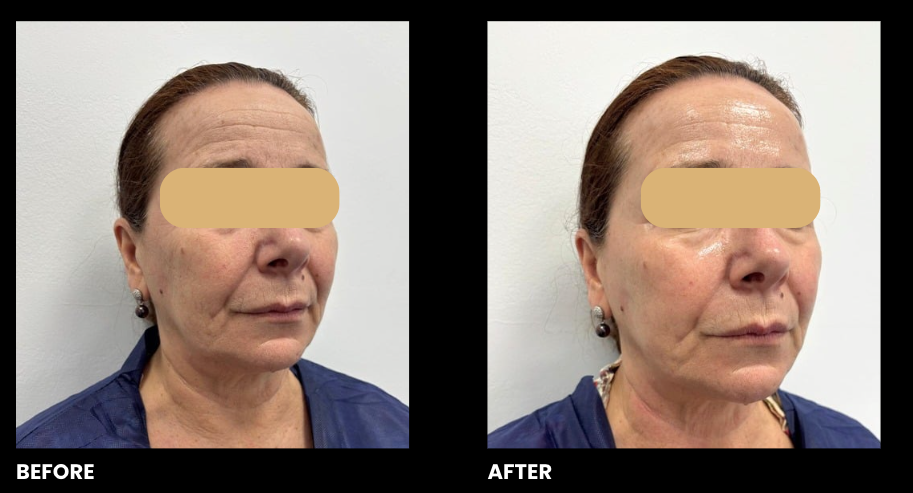 EXO-NAD Chemical Peel