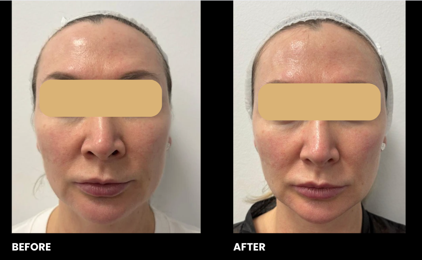 EXO-NAD Chemical Peel