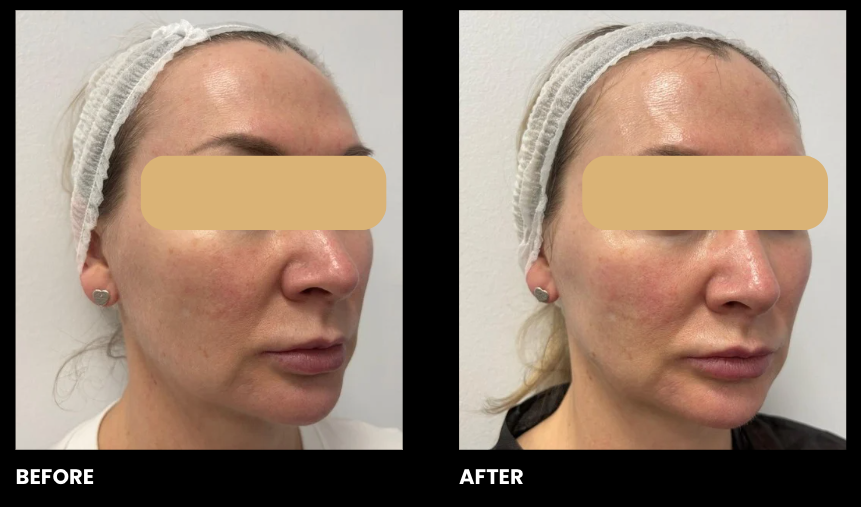 EXO-NAD Chemical Peel